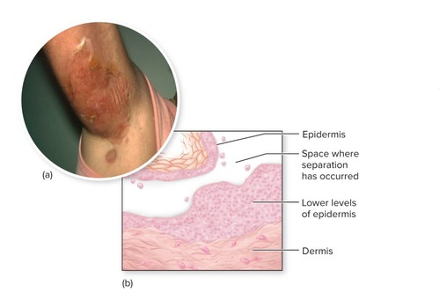 <p>The outermost layer of the epidermis, composed of dead cells that slough off daily.</p>
