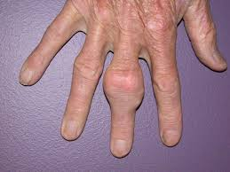 <p>gout</p>