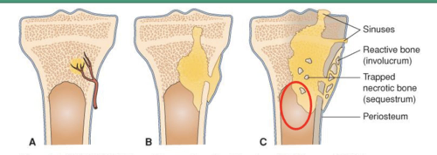 <p>hematogenous osteomyelitis</p>