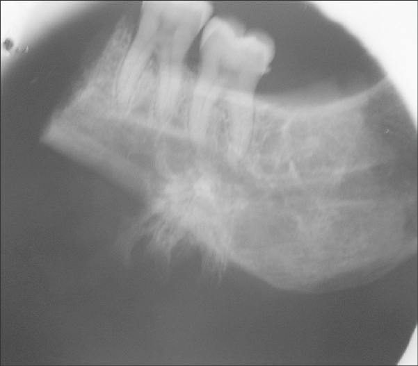 <p>Which classic radiographic feature may be seen with osteosarcoma of the jaws or long bones?</p>