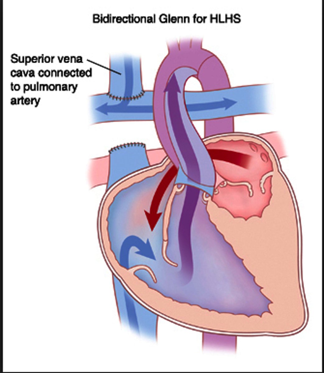 <p>2nd stage of HLHS correction; the SVC is cut and attached directly to the pulmonary arteries and the shunt is removed. This results in the pulmonary arteries receiving deoxygenated blood directly from the SVC</p>