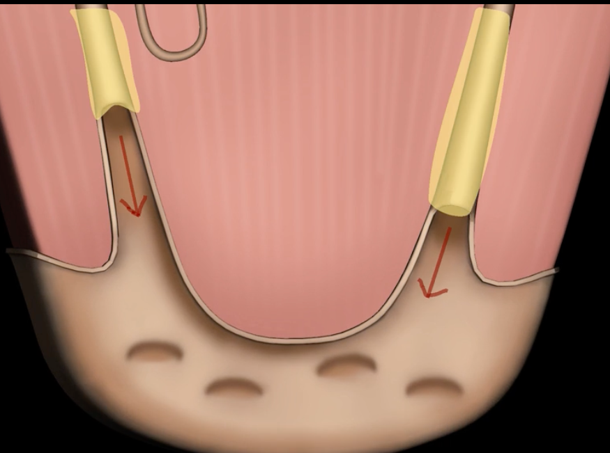 <p>collecting ducts form [ ], which empty into the minor calyx&nbsp;</p>