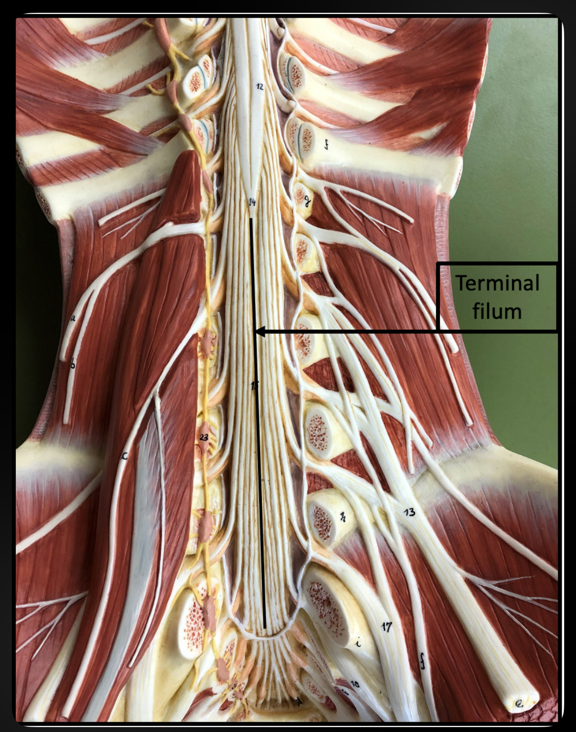 <p>Terminal Filum</p>