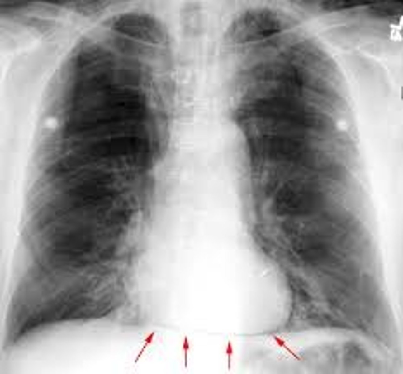 <p>Boundary; X-ray, bottom edge</p>