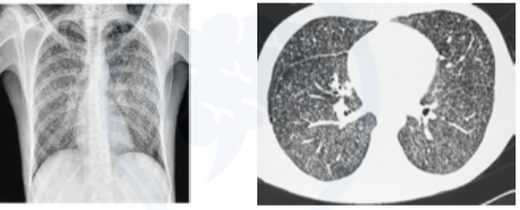 Bilateral randomly distributed nodules