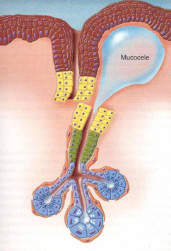 <ul><li><p>Bubble in mucosa that is fluid filled caused by blockage of salivary glands or misalignment of gland and duct</p></li></ul><p></p>