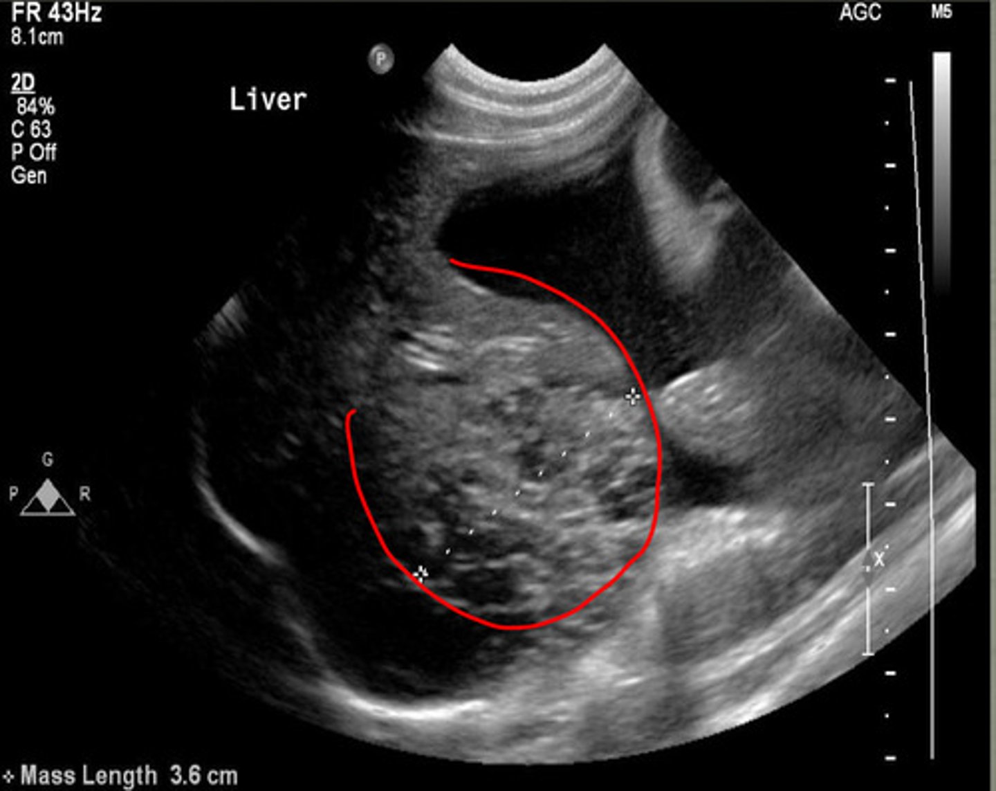<p>what focal change does this show in the liver?</p>
