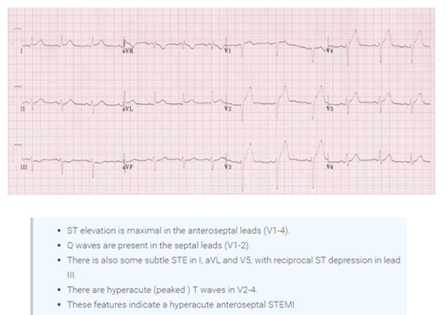 <p>- ST elevation in 2 or more contiguous precordial leads (V1-V6)</p><p>- reciprocal depression in the inferior leads (particularly III and aVF)</p>
