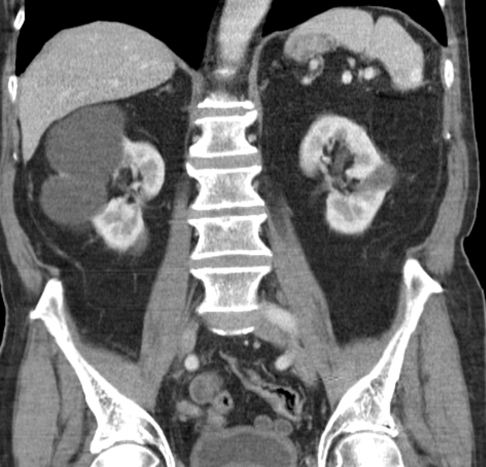 <p>Simple renal cyst findings on U/S and CT</p>