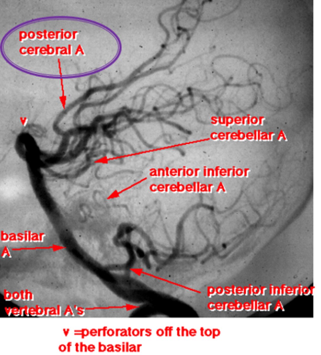 <p>What is the pathophysiology of <strong>migraine</strong>?</p>