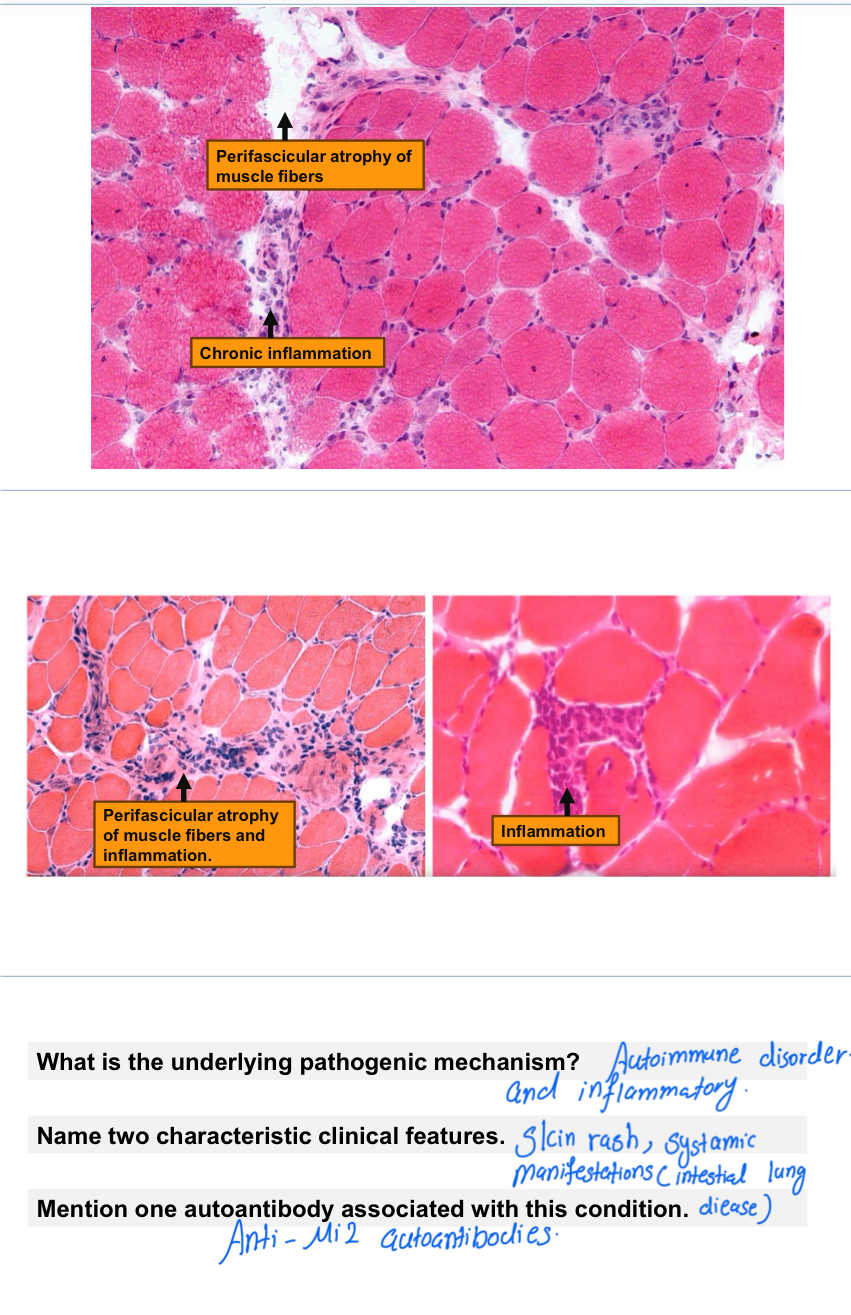 <p><span><strong>Dermatomyositis</strong></span></p>