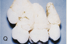 <ul><li><p>excess cementum formation that rarely occurs</p></li><li><p>con man produced too much cementum </p></li></ul><p></p>