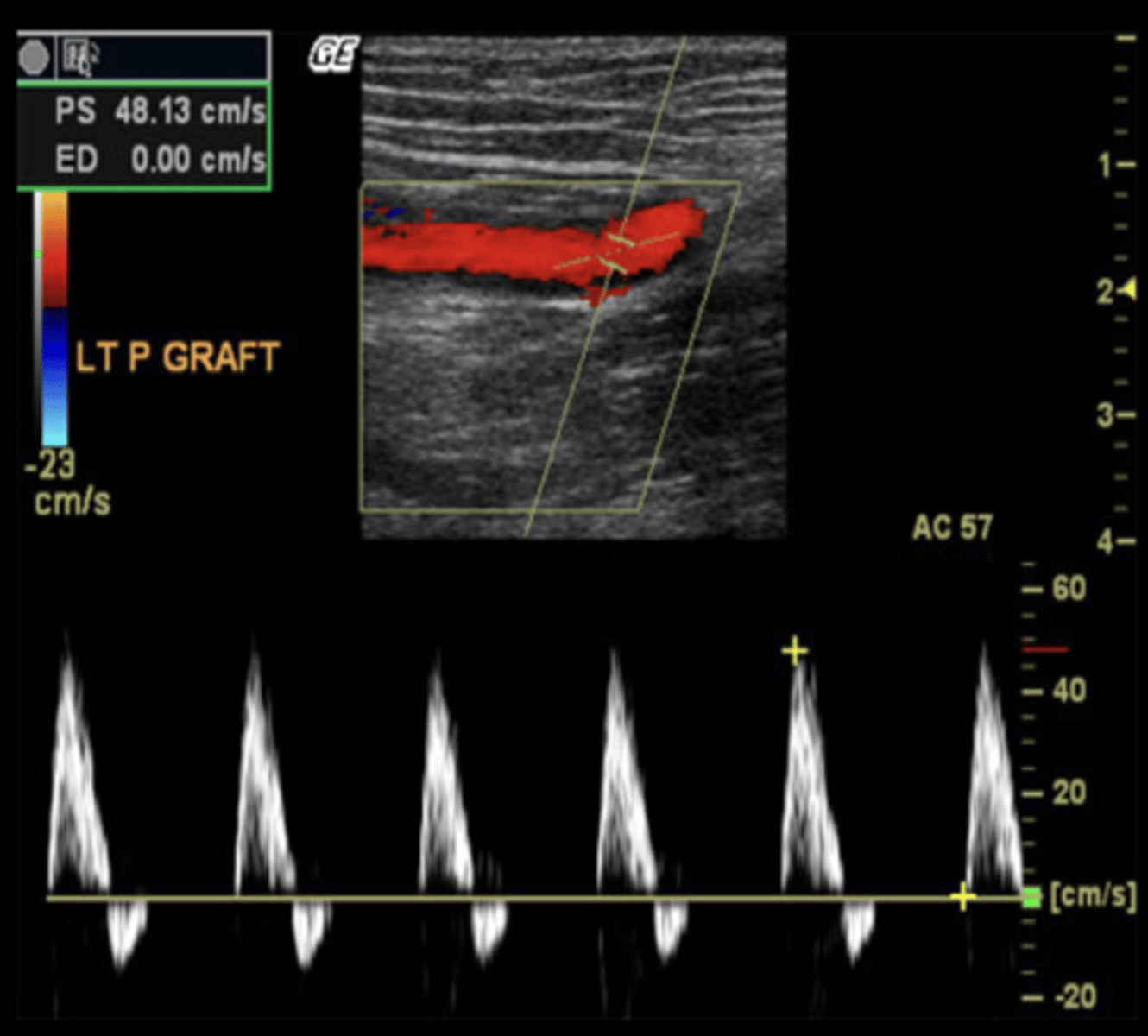 <p>Multiphasic arterial waveform</p><p>Sharp upstroke</p><p>Narrow systolic peak</p><p>Reversal of flow may not be seen early post-op</p>