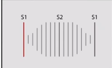 <p>Machinery / continuous murmur</p>