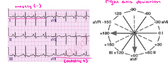 <p><strong>Right Axis Deviation</strong></p><p>-The QRS complex is ________ in Lead I and _______ in aVF</p>