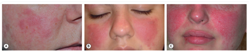Fig. 41.9 Acute cutaneous lupus erythematosus (ACLE). The facial erythema, often referred to as a “butterfly rash” may be variable (A), edematous (B), or have
associated scale (C). The presence of small erosions can aid in the clinical differential diagnosis