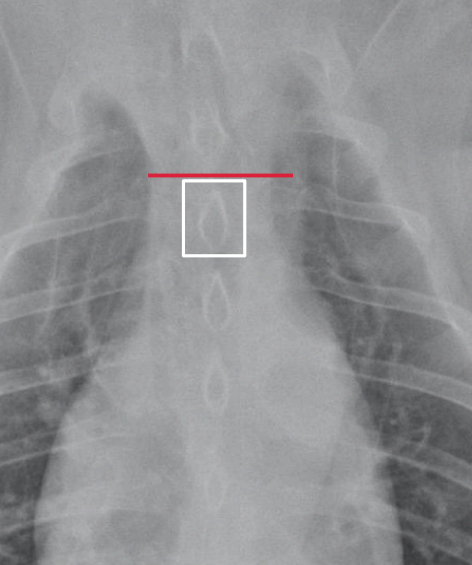 <p>• Normal is &lt;2 mes the width of the vertebra</p><p>• Wider in brachiocephalic and obese dogs</p>