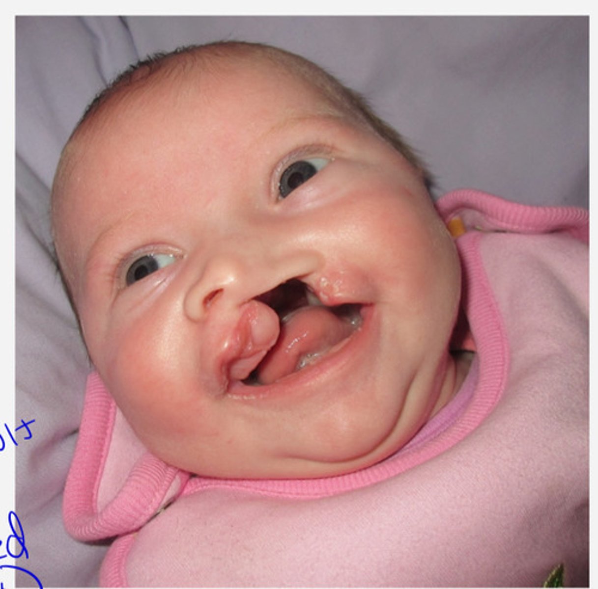 <p>Baby also has cardiac defects and hydrocephalus</p>