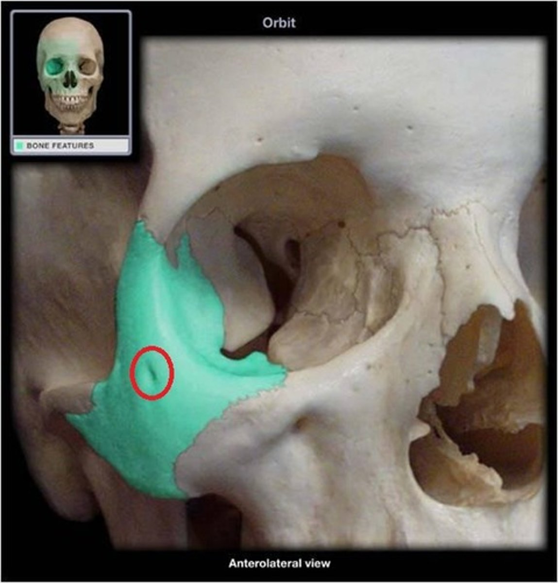 <p>an opening in the zygomatic bone on lateral surface</p>