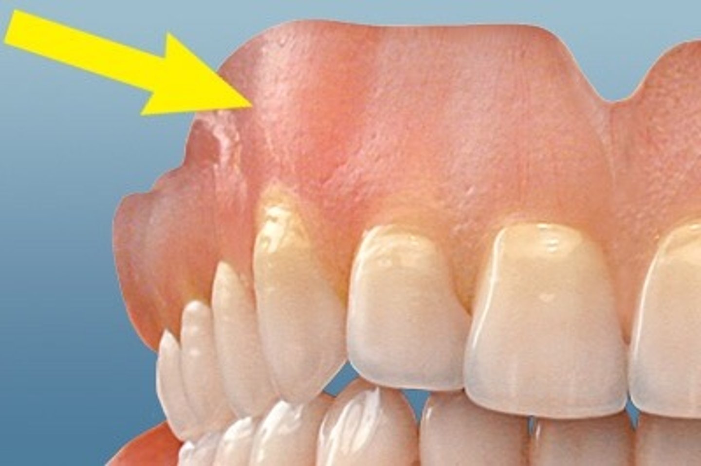 <p>The thick facial plate of bone overlying the canine root that causes a bone projection below the gingiva</p>