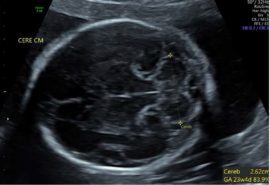 <ul><li><p><strong>see cerebellum in transverse plane</strong></p></li><li><p>angle inferiorly from BPD image</p></li></ul>