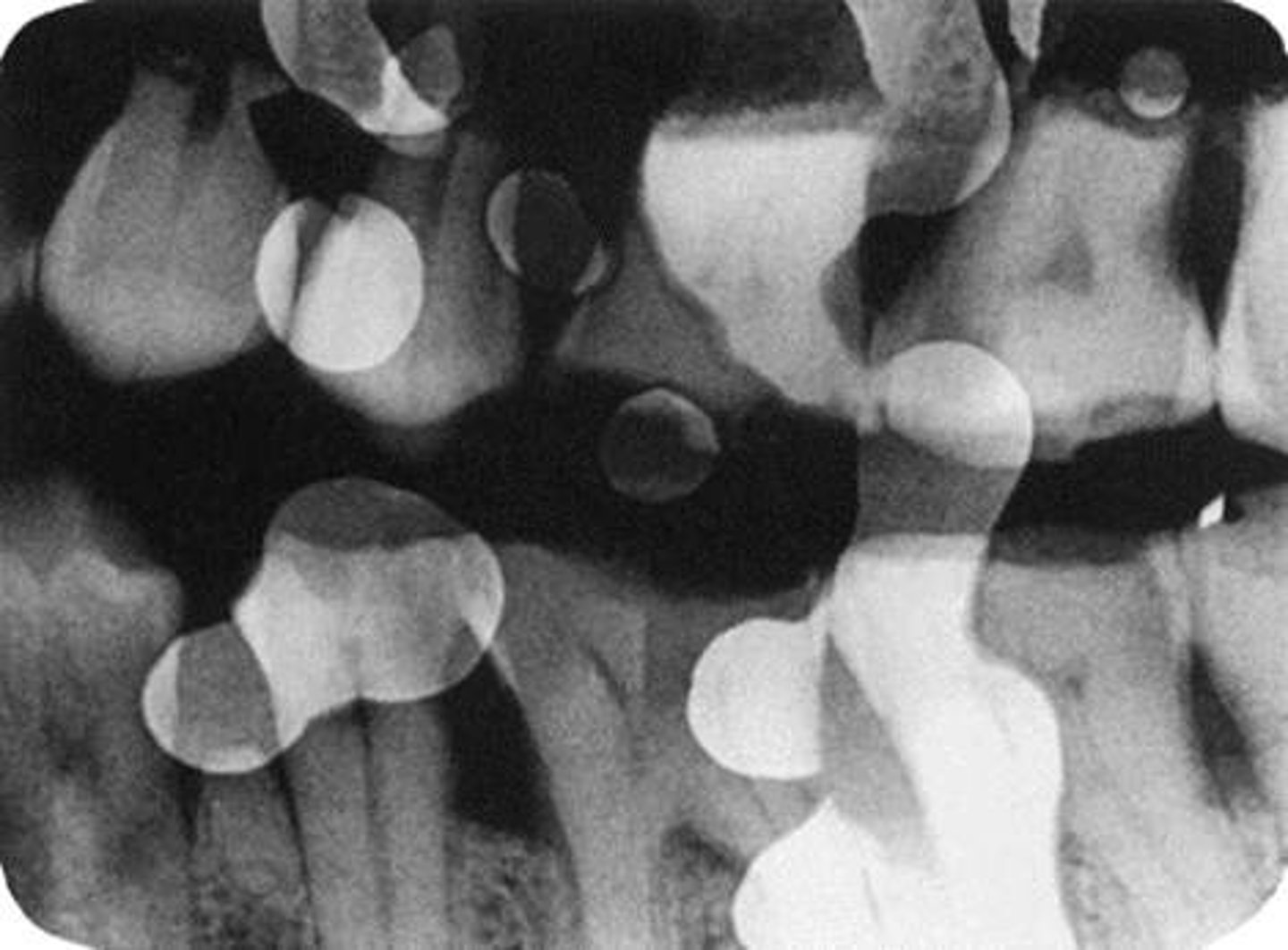 <p>white or light spots, fixer comes in contact with film before processing</p>
