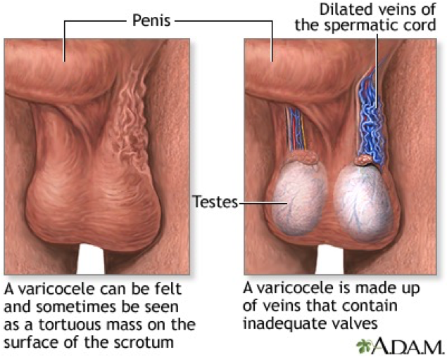 <p>Varicocele</p>