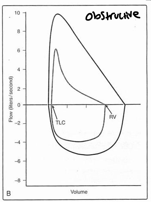 <p>In asthma and emphysema, the curves are displaced to the <strong>left </strong>because of air trapping and/or hyperinflation, and the portion of the expiratory curve from the peak flow to residual volume is characteristically <strong>concave </strong>due to airflow limitation.</p>