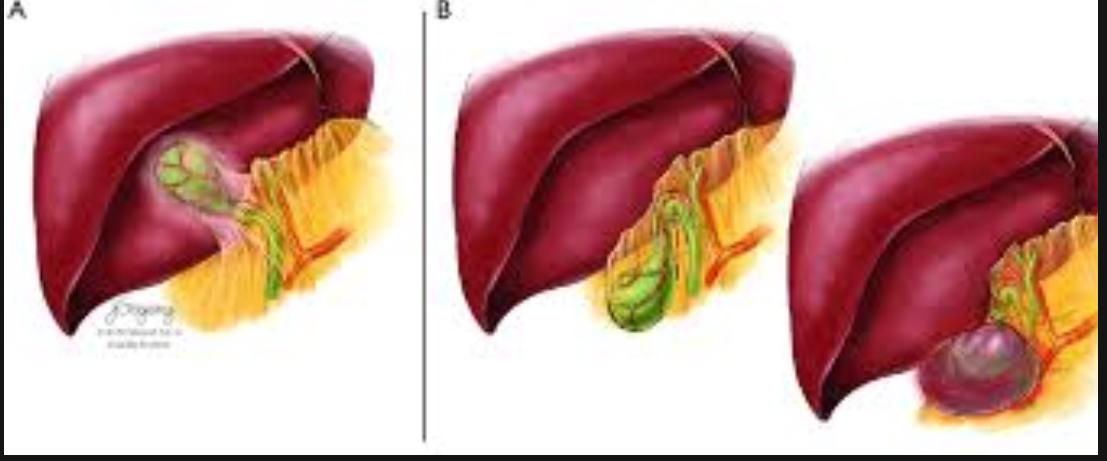 <p>G<span>B twists on mesentery; elderly or congenital; surgical emergency </span></p><p><span>Enlarged, floating GB; whirlpool sign; hyperemic early, avascular later; abnormal orientation </span></p>