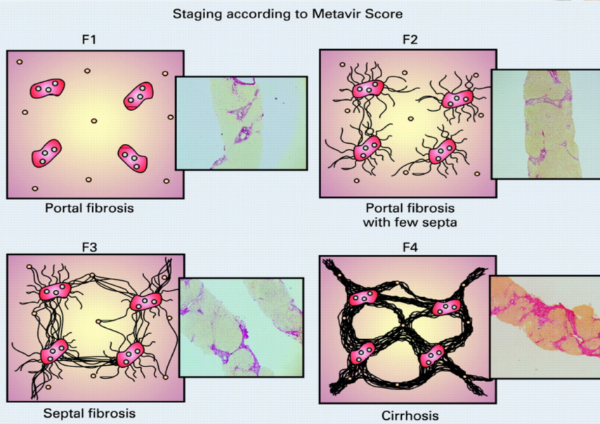 <p>F1: portal fibrosis</p><p>F2: portal fibrosis with few septa</p><p>F3: Septal Fibrosis</p><p>F4: Cirrhosis</p>