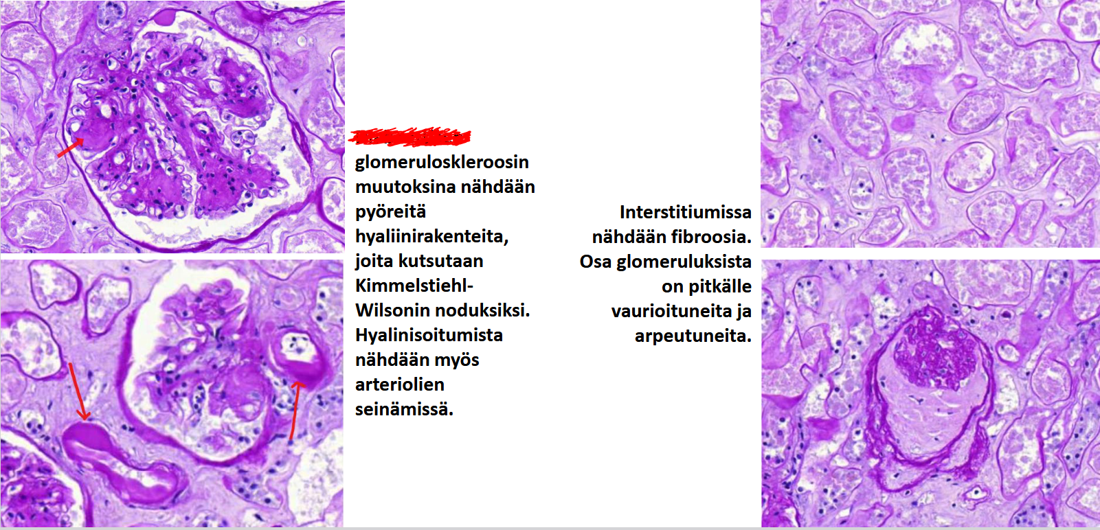 <p>mikä tauti on kyseessä? Päättele kuvista ja tekstistä</p>