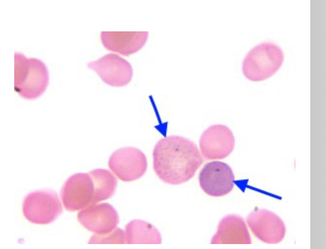 <p>This abnormalities are associated with</p>