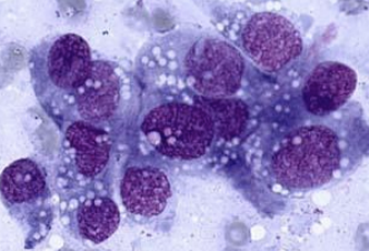 <p>What cells on an FNA will have a round-ovoid nucleus, spindle-fusiform cytoplasm with a wispy tail, exfoliating cells and clumps, and are representative of sarcoma?</p>