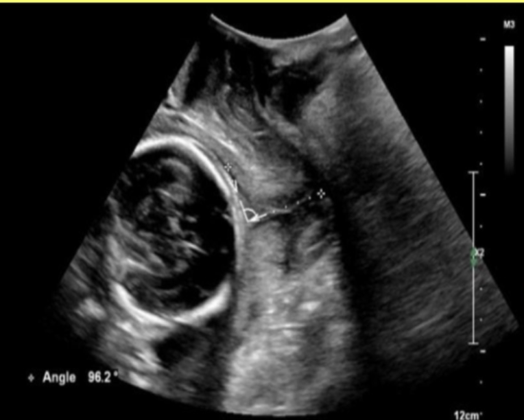 <p>a pt at 36w for cervical length measurement. she says she has been <strong>leaking amniotic fluid</strong> for the last few hours. </p><p>.</p><p>how should the cervical evaluation be performed</p><p>.</p><p>a) TV approach, empty bladder, sag image</p><p>b) cervical measurement cannot be performed on this pt</p><p>c) TA approach, moderate bladder distension, sag image</p><p>d) translabial approach, empty bladder, sag image</p>
