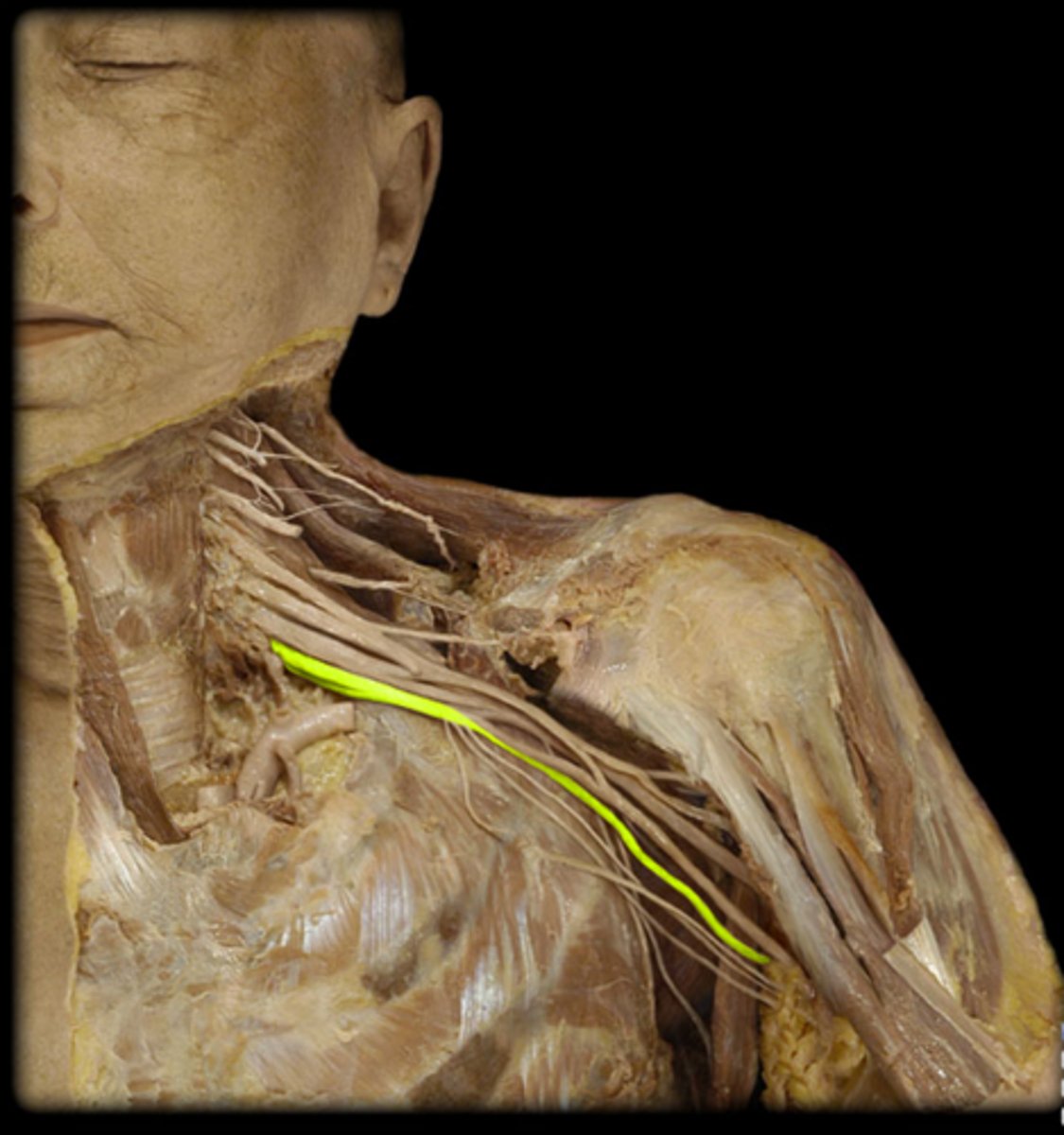 <p>between median and medial antebrachial nerves</p>