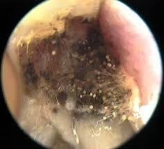 <p>Do you think this is an example of a fungal infection (otomycosis) or cerumen impaction? </p>