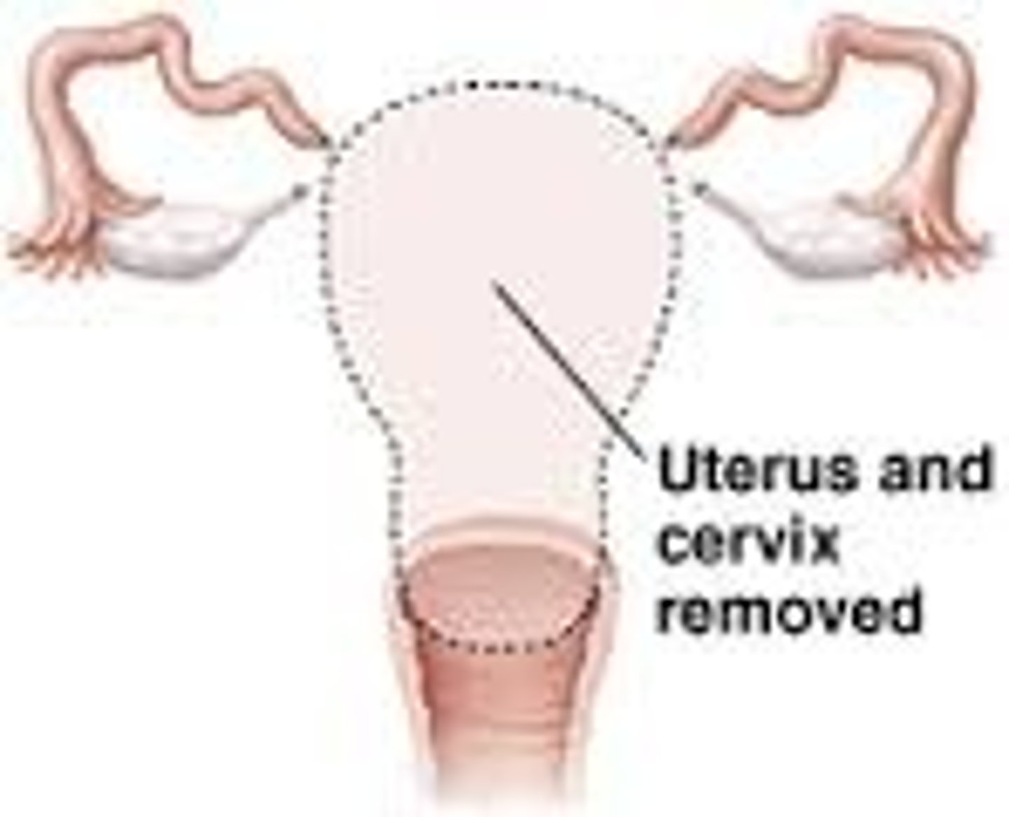 <p>Surgical removal of the uterus.</p>