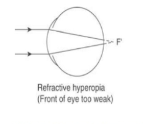 <p>refractive hyperopia&nbsp;</p>