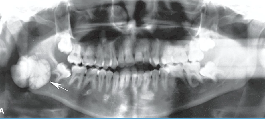 <p>homogeneously radiopaque lesion with <strong>NO PERIPHERAL lucent</strong> rim</p>