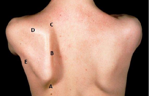 <p>A: angulus inferior B: margo medialis C: angulus superior D: margo superior E: margo lateralis</p>