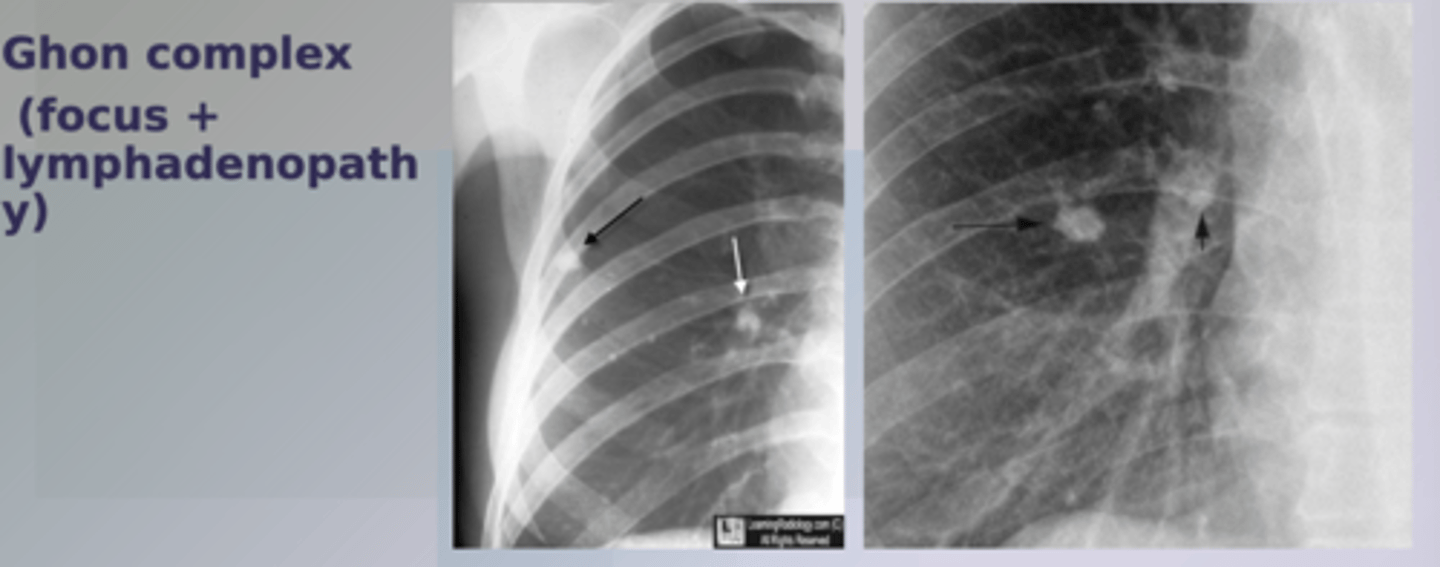 <p>-initial infection </p><p>-patho: inhaled &gt; deposition in alveoli &gt; forms Ghon focus&gt; spread to hilar lymph nodes via drainage &gt; go away(5%), latent infection(90%), or primary disease(5%) </p>
