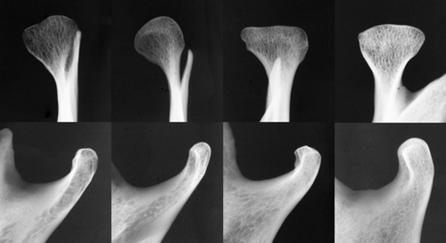 <p>When is complete calcification of the cortical boarders of the condyle completed? What would be indicated by lack of cortication after that time?</p>