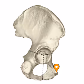 <p>lateral end of the pubic crest </p>