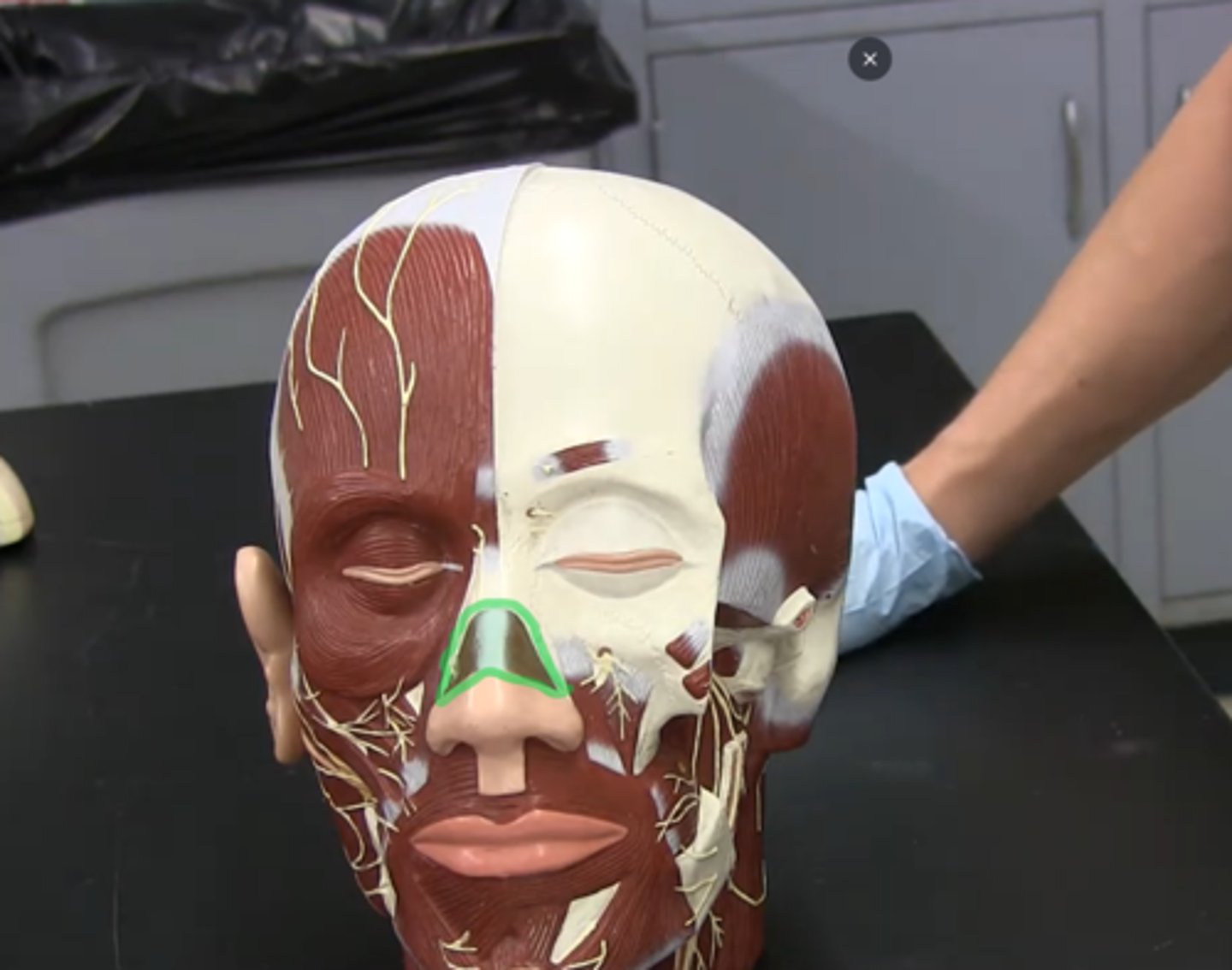 <p>Horizontal striations across bridge of the nose.</p>