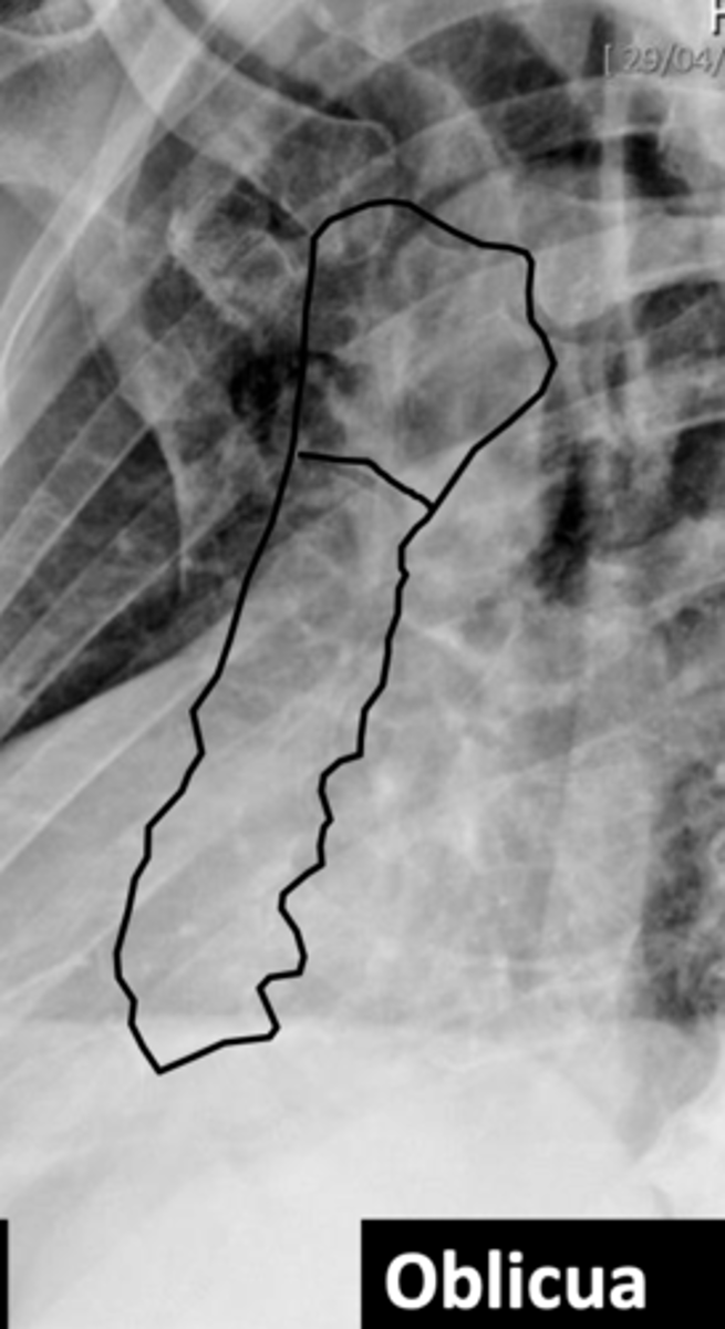 <p>A left anterior oblique projection is used to better differentiate the sternum's portions (manubrium, body, and xiphoid process) by avoiding overlap with the spine and mediastinum.</p>
