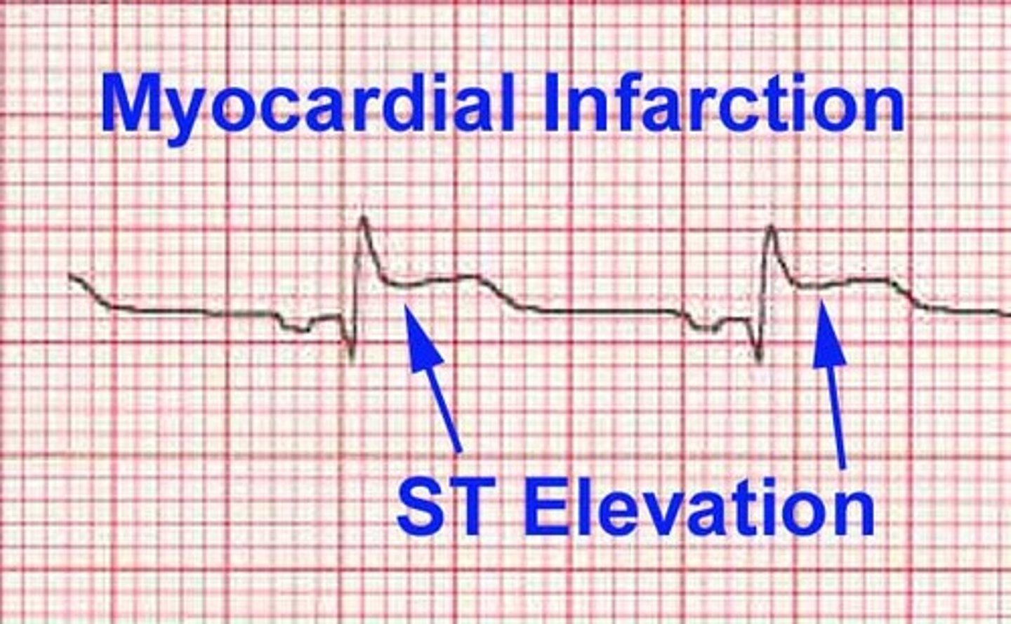 <p>indicates myocardial infarction (HEART ATTACK!!!!!) usually referred as a STEMI</p>
