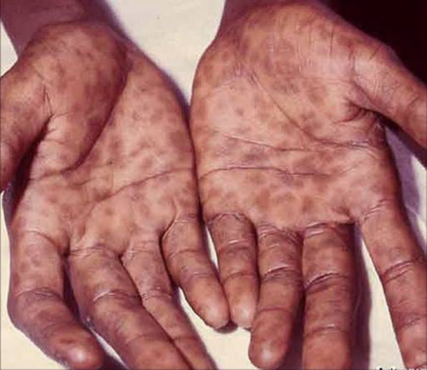 <p>-rash on PALMS AND SOLES</p><p>-epitrochlear lymphadenopathy</p><p>-alopecia</p>