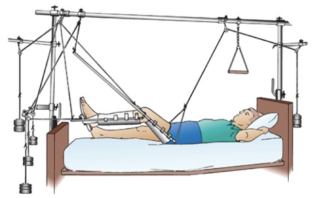 <p>skeletal traction</p>