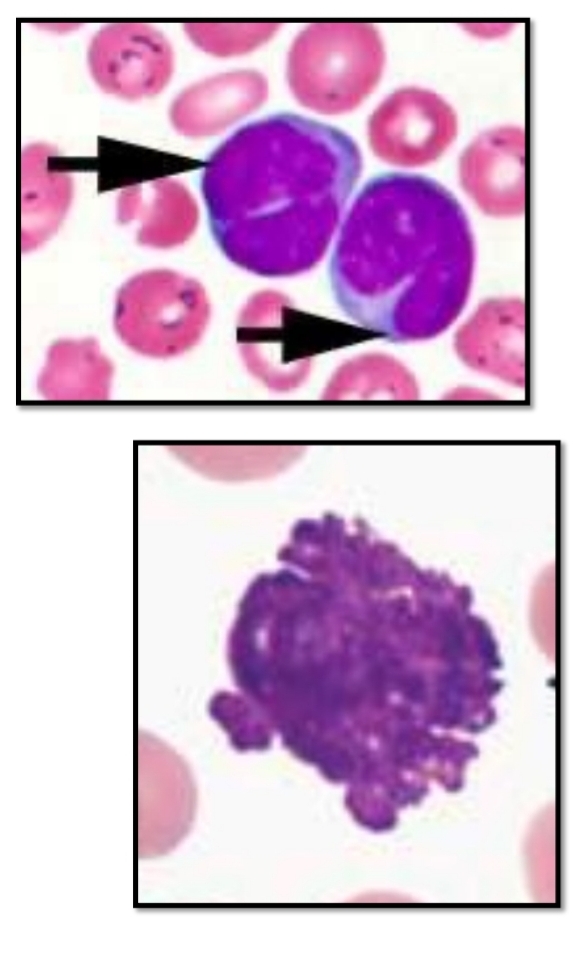 <ul><li><p>Smudge cells</p></li><li><p class="has-focus">Rieder cells</p></li></ul><p></p>