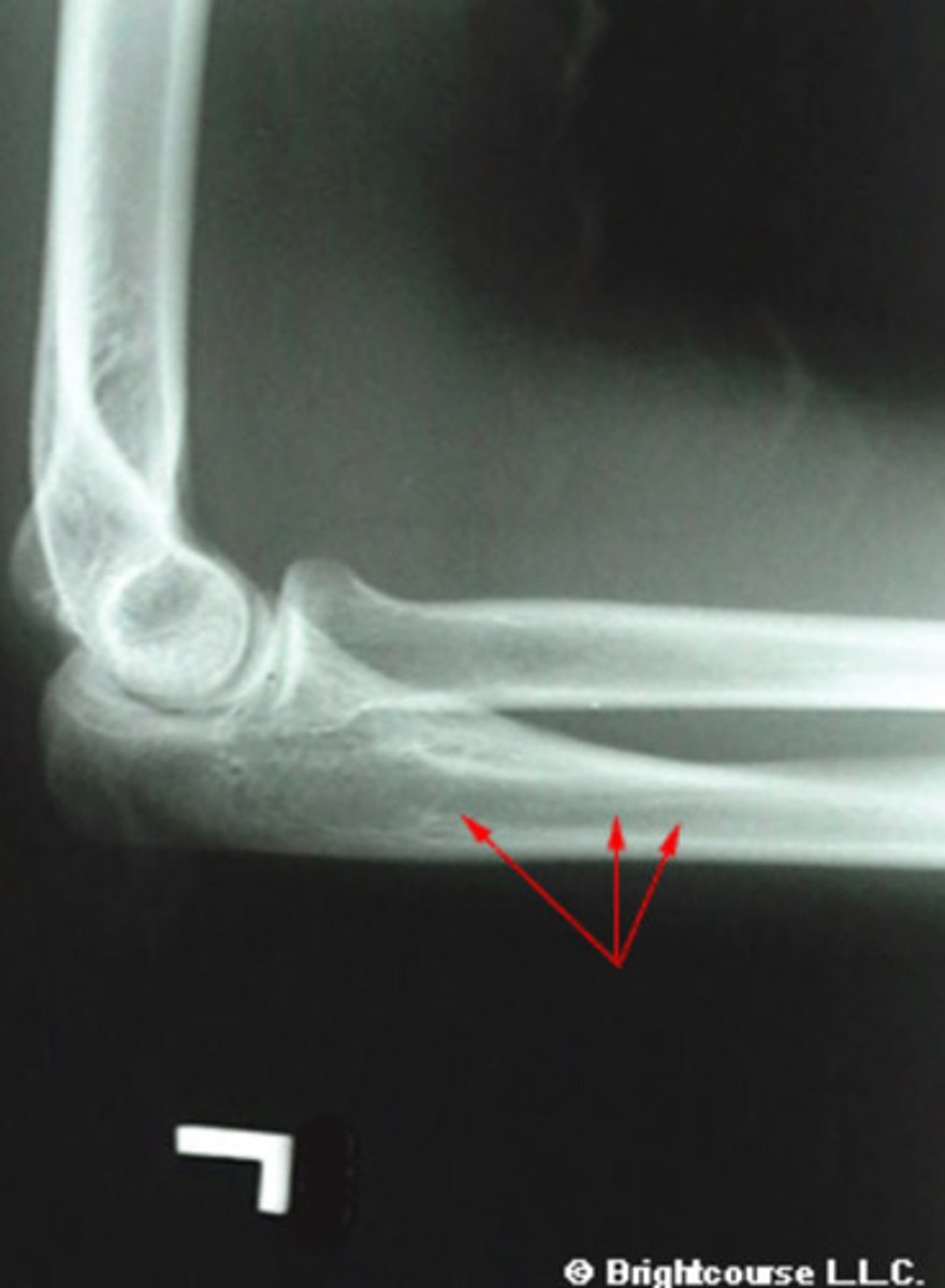 <p>What structure is being pointed out by the arrows?</p>